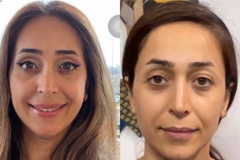 بلفاروپلاستی یا لیپوفیس