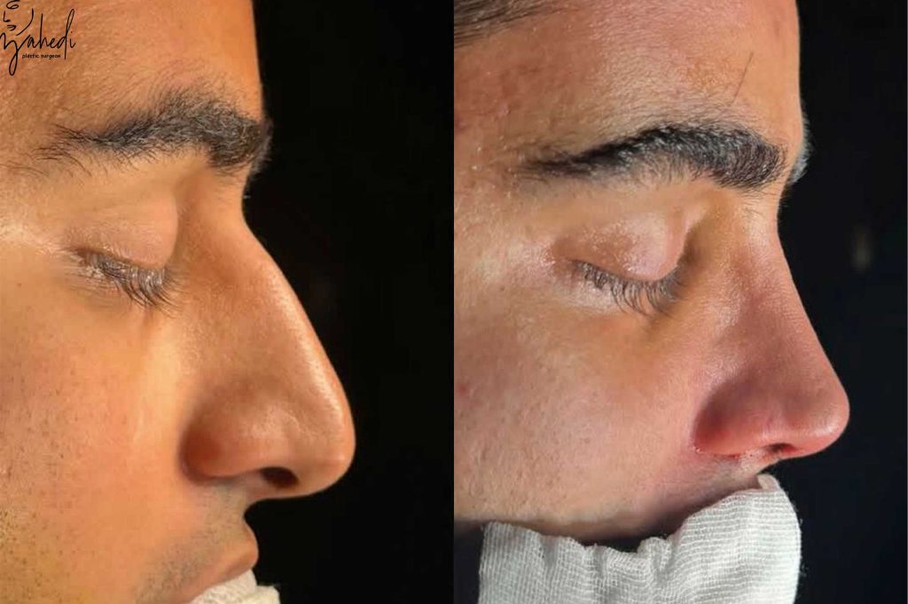 تفاوت رینوپلاستی طبیعی و فانتزی