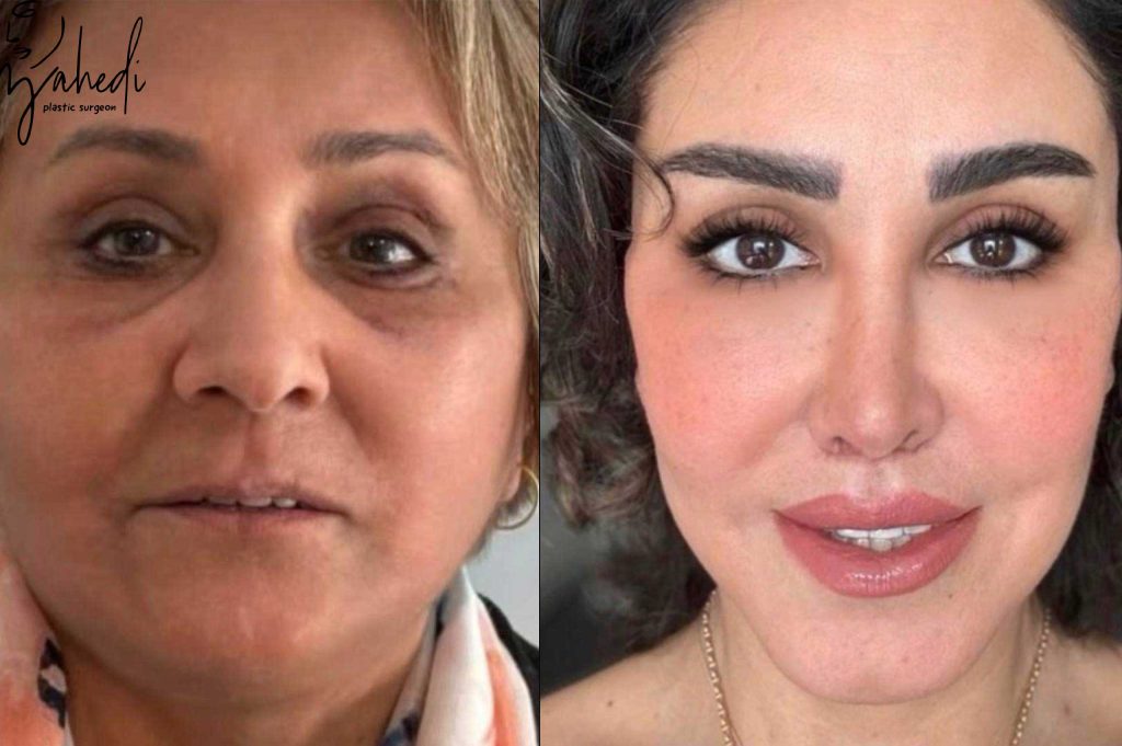 تفاوت اندوسکوپی شقیقه با لیفت کامل صورت