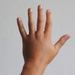 تصویر بعد از درمان