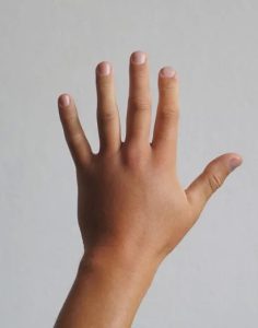 جراحی دست - بعد از درمان