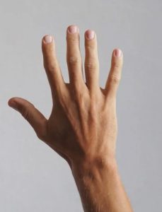 جراحی دست - قبل از درمان