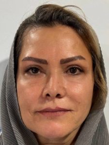 لیفت صورت - بعد از درمان