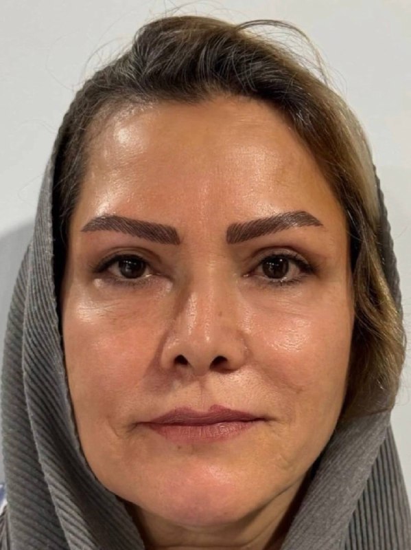 تصویر بعد از درمان