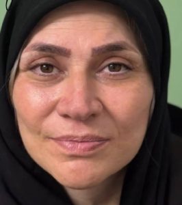 لیفت صورت و گردن - بعد از درمان