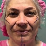 تصویر قبل از درمان