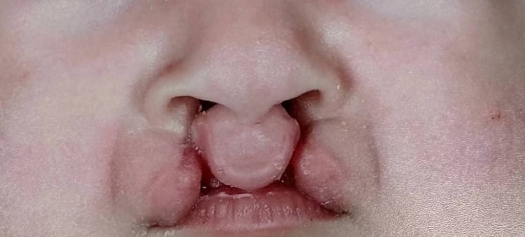 شکاف لب و کام چیست؟