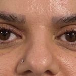 تصویر بعد از درمان