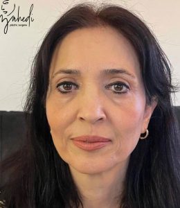 بلفاروپلاستی - بعد از درمان