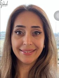 بلفاروپلاستی - بعد از درمان