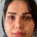 تصویر بعد از درمان