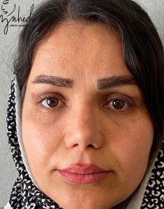 بلفاروپلاستی - بعد از درمان