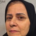 تصویر بعد از درمان