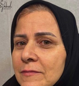 بلفاروپلاستی - بعد از درمان