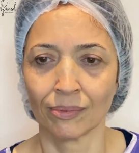 بلفاروپلاستی - قبل از درمان