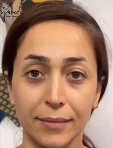 بلفاروپلاستی - قبل از درمان