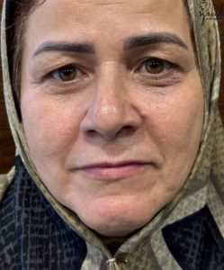 بلفاروپلاستی - قبل از درمان