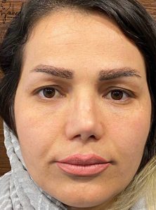 بلفاروپلاستی - قبل از درمان