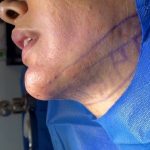 تصویر بعد از درمان