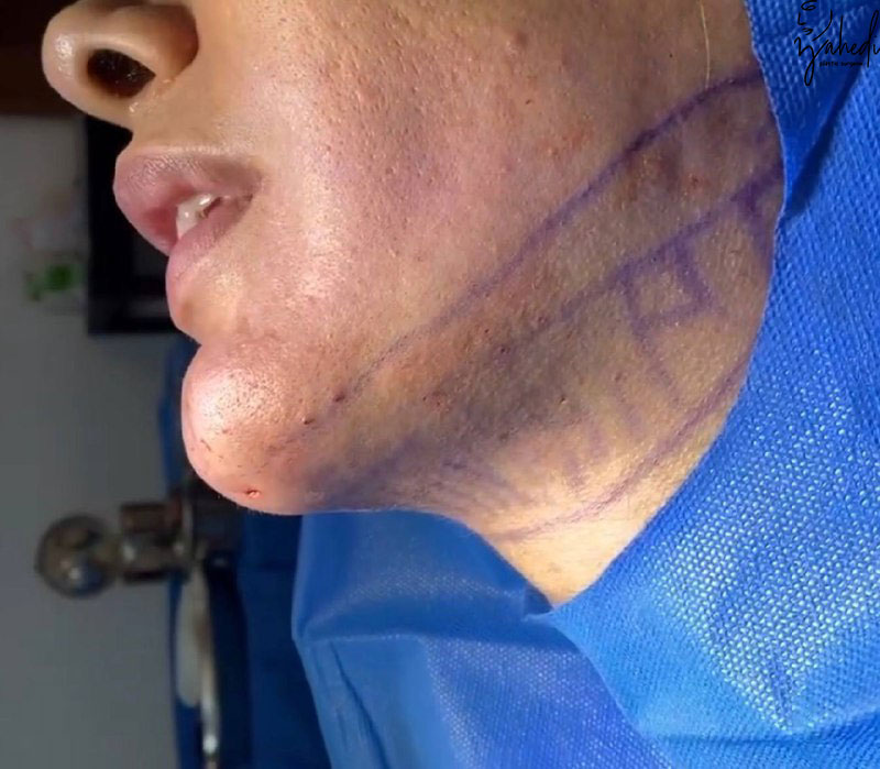 تصویر بعد از درمان