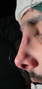 رینوپلاستی - بعد از درمان