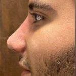 تصویر بعد از درمان