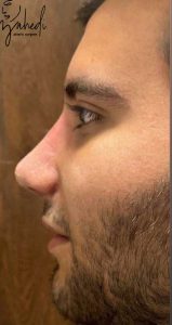 رینوپلاستی - بعد از درمان