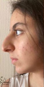 رینوپلاستی - قبل از درمان