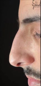 رینوپلاستی - قبل از درمان