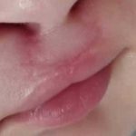 تصویر بعد از درمان