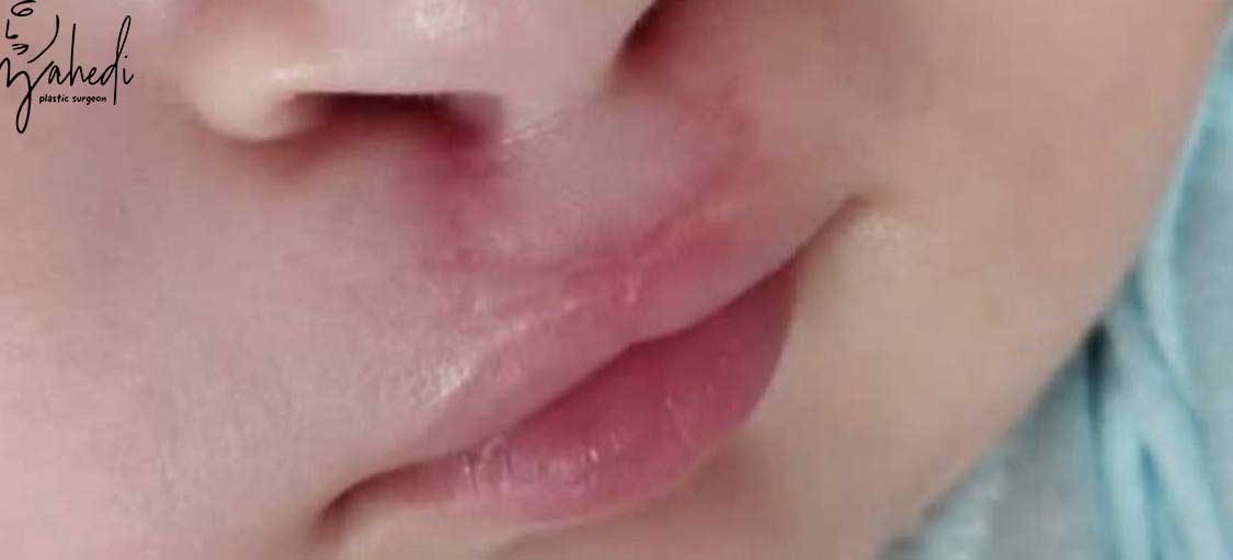 تصویر بعد از درمان