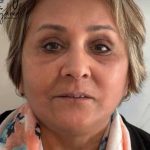 تصویر بعد از درمان