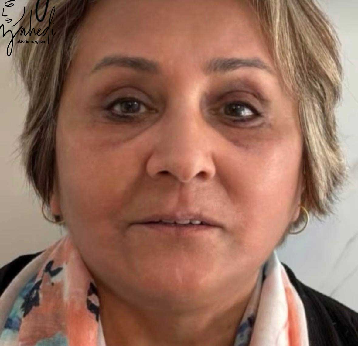 تصویر بعد از درمان