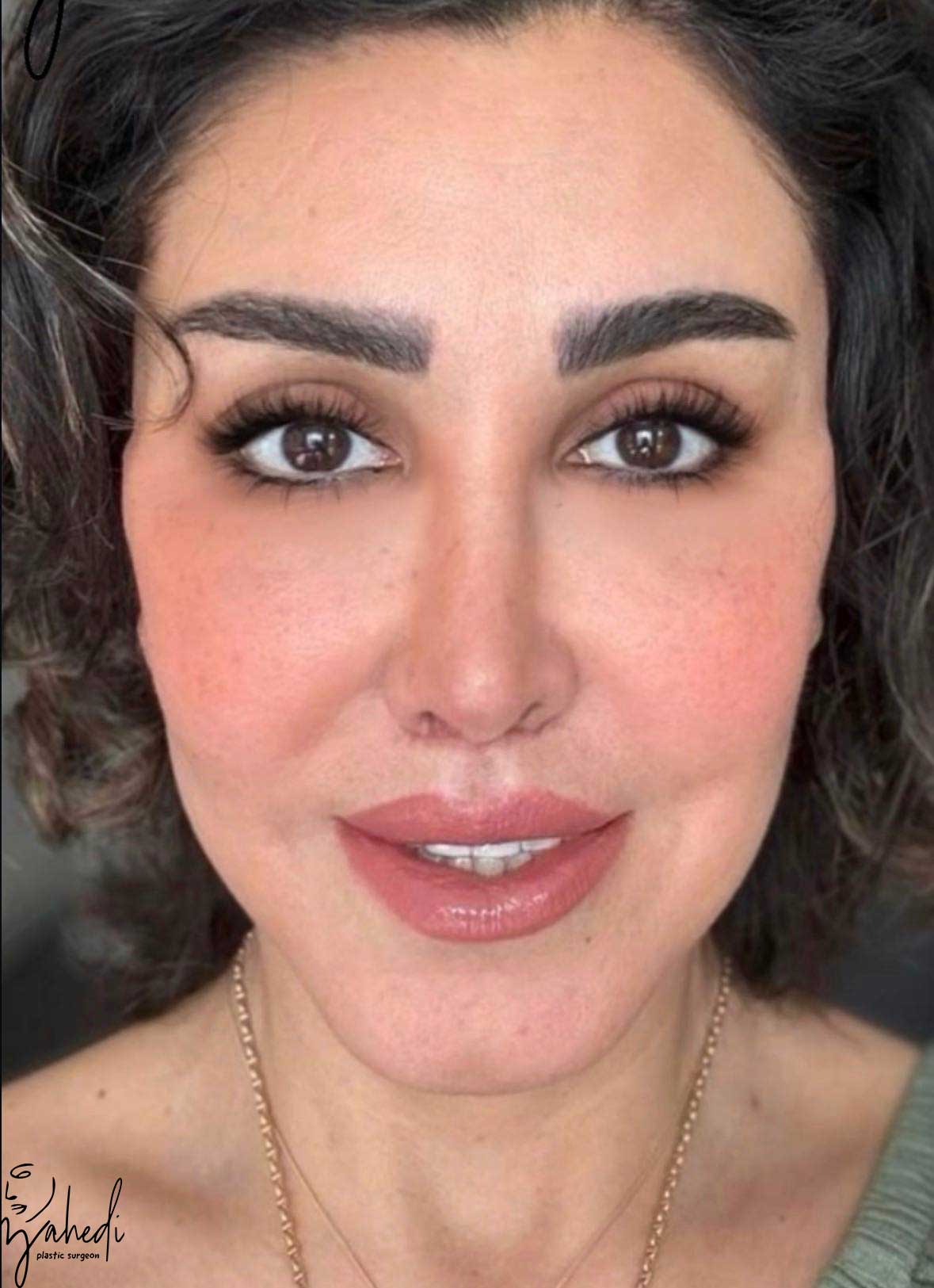 تصویر بعد از درمان